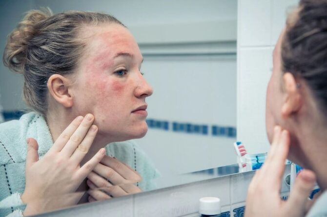 Maladies chroniques de la peau au stade de la détérioration