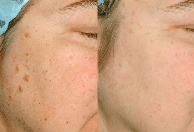 Retirer la pigmentation sur la peau