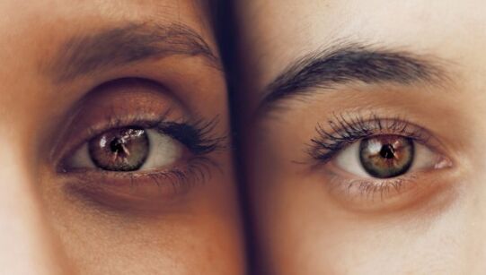 Cercles sombres sous les yeux