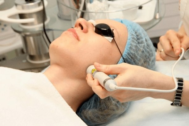 Biorétisation laser