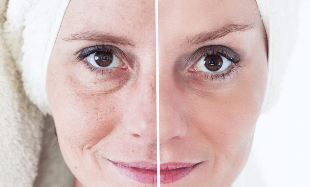 Rajeunissement du visage au laser